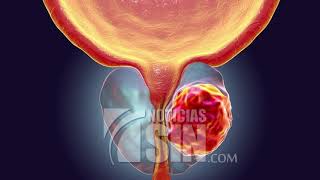 Hombres mayores de 45 años es vital visiten el urólogo