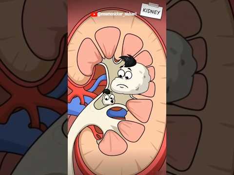 Renal Colic: जब पथरी पतले रास्ते में फँस जाए!” 😣 #kidneystone #medicalanimation #medicalfacts #viral