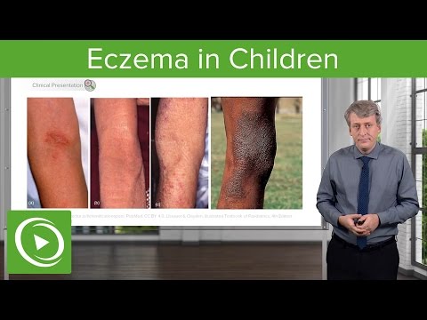 Dolore di gamba di psoriasi Comprare la crema dermaleks atopik la crema di eczema