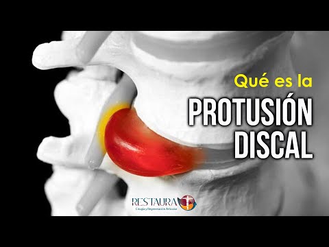 ¿Qué es la protusión discal? ¿No es lo mismo que la hernia de disco?
