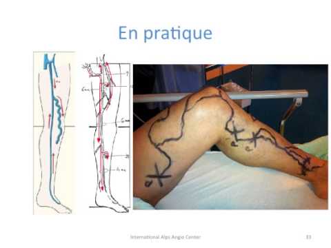 comment traiter l'insuffisance veineuse