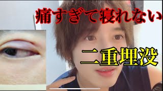 【二重埋没】二重整形から1か月経った経過を話します！