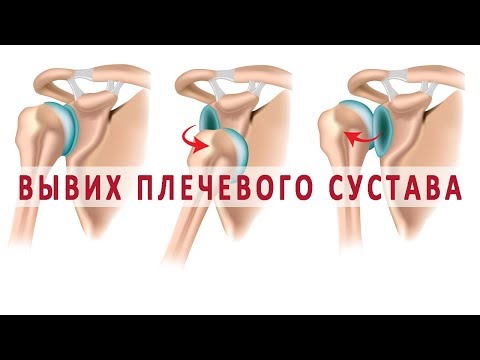 Что нужно знать о вывихе плечевого сустава