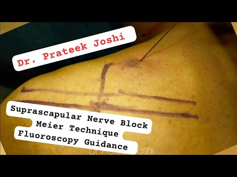 Suprascapular Nerve Block Procedure | Meier Technique + Fluoroscopy Guidance | Dr. Prateek Joshi
