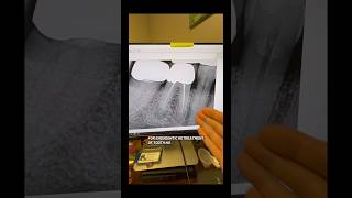 One appt retx and sealer extrusion! Will tx fail?! #dentists #rootcanaltherapy #endodontist