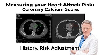 Measuring your Heart Attack Risk: Coronary Calcium Score: History, Risk Adjustment