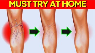 Top 6 PROVEN WAYS To Help You Treat VARICOSE VEINS Righ At Home