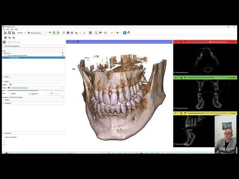 In-house Aligners and DIY solutions - Part 1