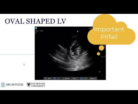 Basic cardiac POCUS: image acquisition
