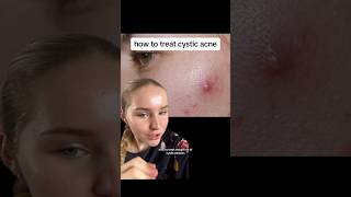 how to treat cystic acne!! #acne #skincare #shorts