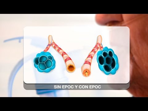 BO EPOC: qué es y su tratamiento 