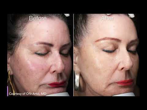 ULTRApulse Alpha – Alpha Air Brush facial resurfacing (short)