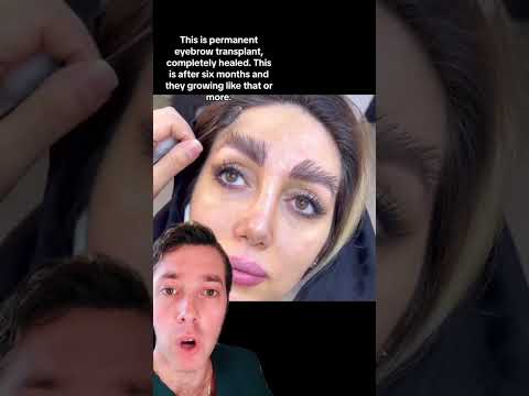 Eyebrow Hair Transplant?!