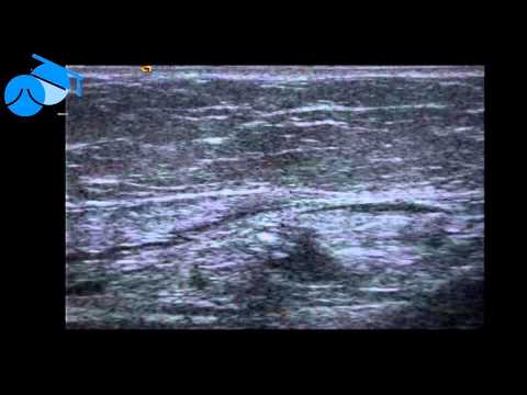 Ultrasound videos of a varicose vein before and after Endovenous Laser Ablation (EVLA)