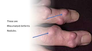 Rheumatoid Nodules: Image of the Month