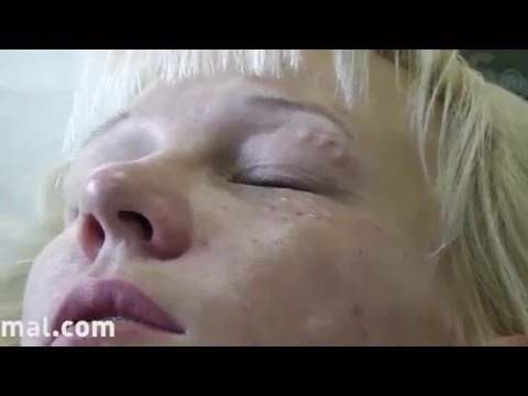 Associazioni cosmetiche per la persona Hypostases dopo un blefaroplastika di occhi asiatici