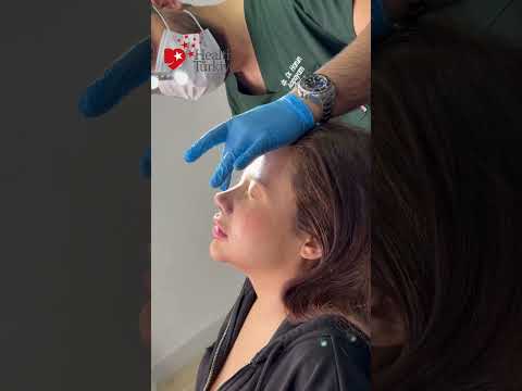 Cast removal after thick skin rhinoplasty✨