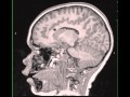 Tuberous Sclerosis with Subependymal Giant Cell Astrocytoma