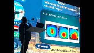 Suitable Keratoconus patient for ICRS