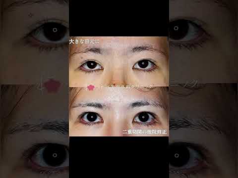 医学科 眼瞼下垂手術後の他院修正　二重をきっちり折り、瞼を薄くする