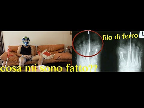 La stenosi spinale cervicale prezzo chirurgia Temperatura del 37,2 dolori articolari