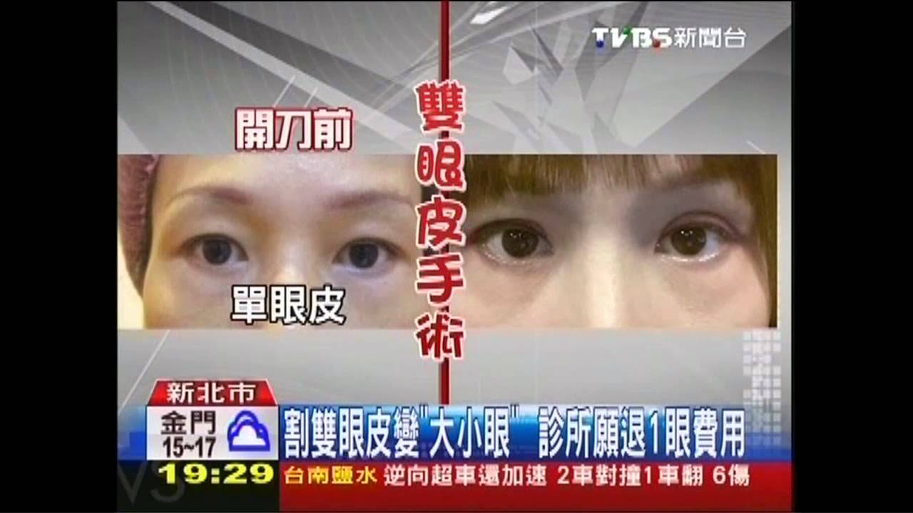 割雙眼皮變「大小眼」 診所願退1眼費用