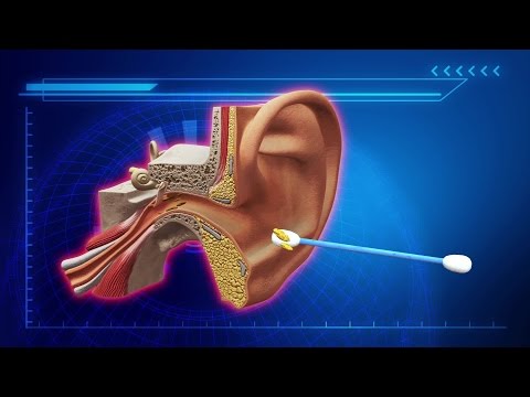 Stop cleaning wax out of your ears, U.S. doctors say