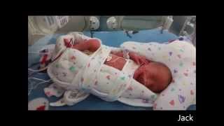 preview picture of video 'Our journey with premature twins'