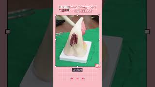 소음순비대, 소음순비대칭 개선하는 소음수술 전후, 소음순성형 전과정 보여드려요~