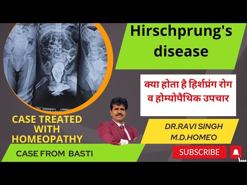 What is Hirschsprung’s disease- A realtime cured case