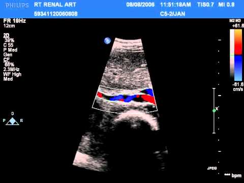 Renal Artery Dissection
