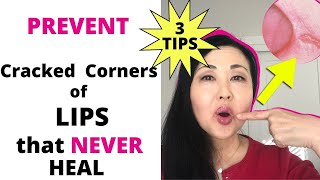 Prevent Cracked Corners of your Mouth that NEVER Heal 3 Tips to Prevent Angular Cheilitis