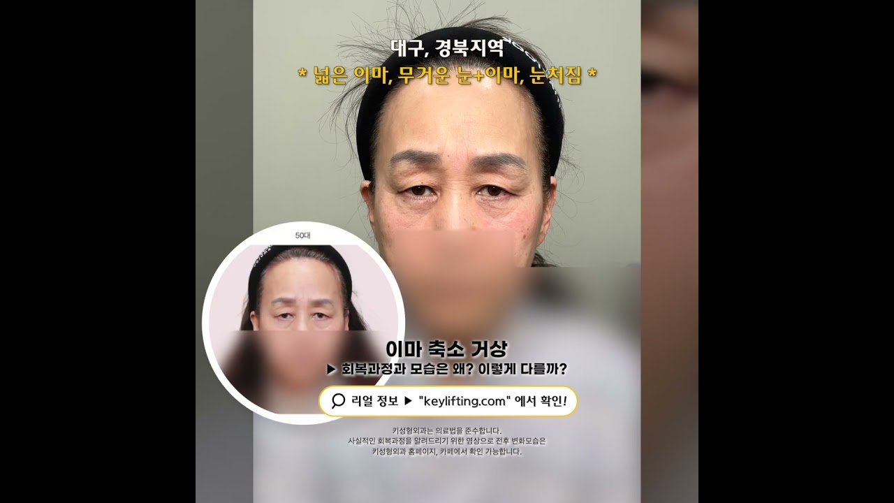 50대중반, 이마축소 거상 