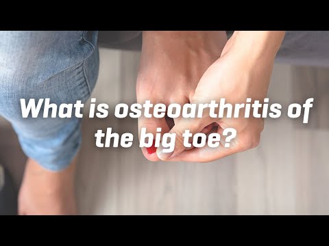 What is osteoarthritis of the big toe?