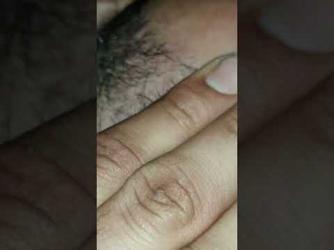 #ingrownhair #hair #remove #asmr #trending #hairremoval #natural #waxing #maazsafder #beard