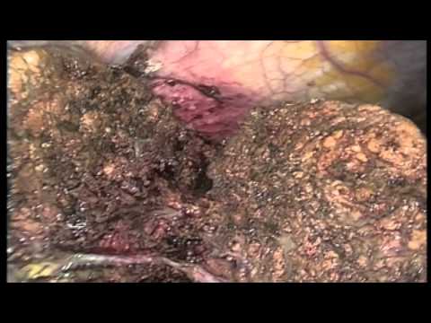 comment soigner cirrhose du foie
