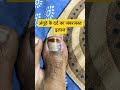 अंगूठे का दर्द का इलाज देख लो Shorts
