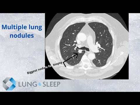 Multiple pulmonary nodules. Are they cancer?
