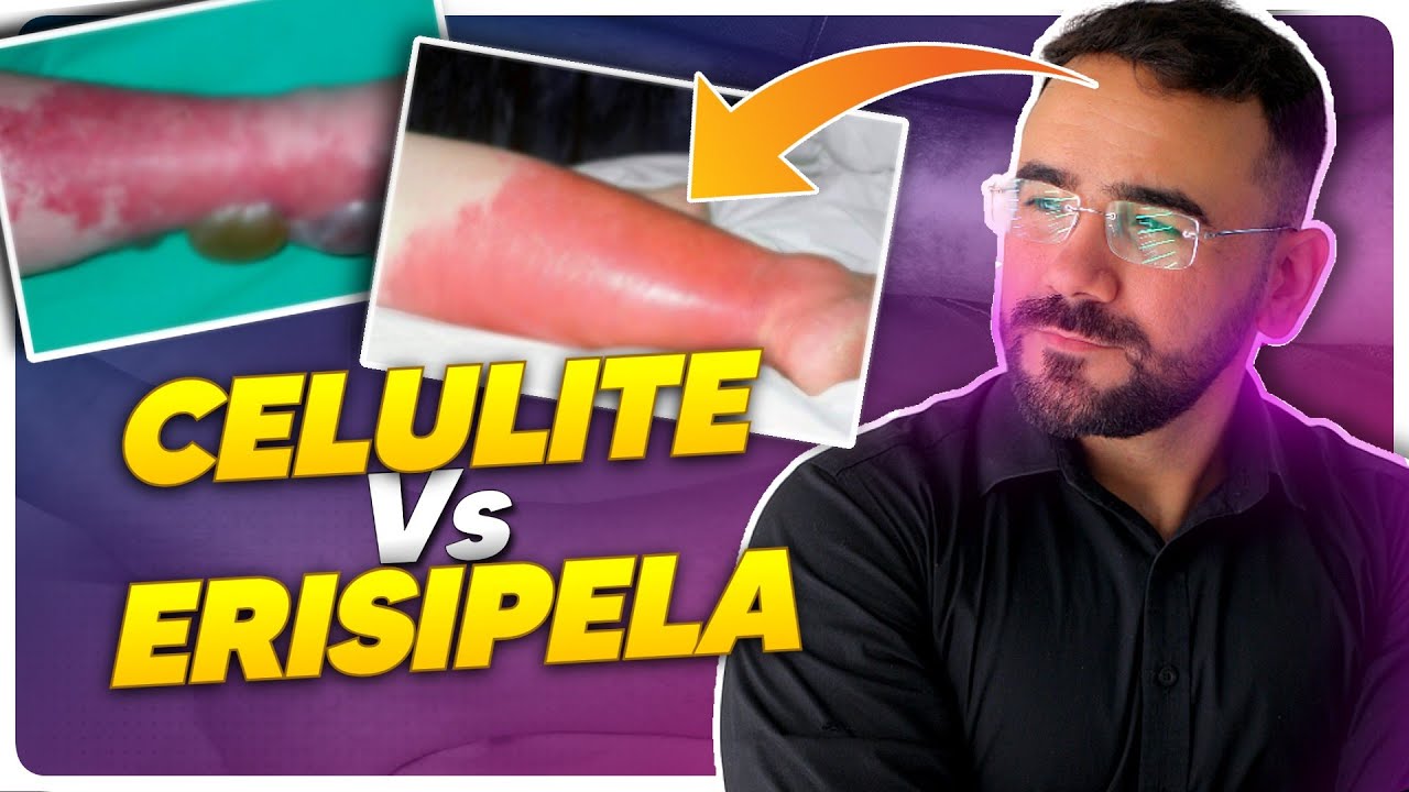 ERISIPELA E CELULITE: QUAL A DIFERENÇA ENTRE ERISIPELA E CELULITE? APRENDA AGORA