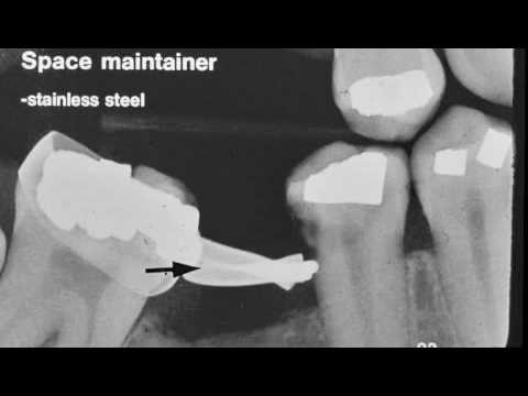 Dental Radiograph Pathology & Restorations (part 2)