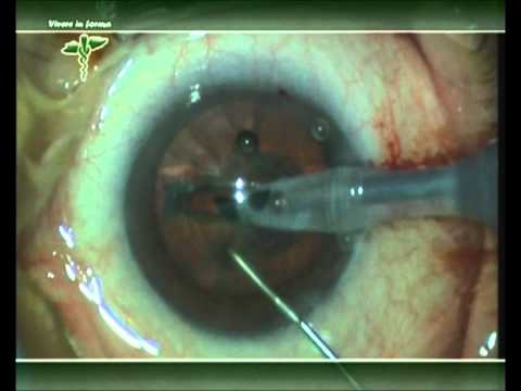 Che riempire rughe sotto stucco di occhi con Il dispositivo per procedure cosmetiche su una faccia