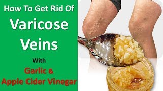 How To Get Rid Of Varicose Veins Fast With Garlic & Apple Cider Vinegar