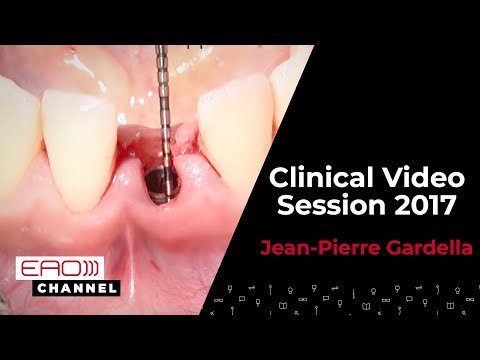 Jean Pierre Gardella / Clinical Video Session 2017