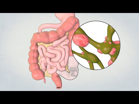 Cpt Code For Sigmoid Colectomy