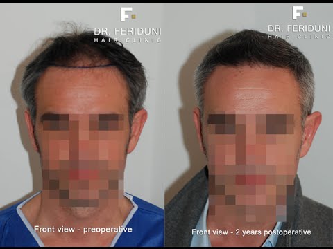 download lagu mp3 mp4 Haartransplantation 2000 Grafts, download lagu Haartransplantation 2000 Grafts gratis, unduh video klip Haartransplantation 2000 Grafts
