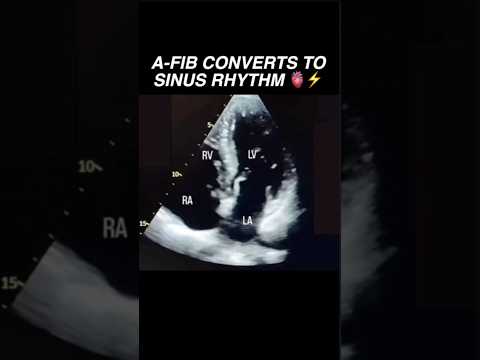 Atrial Fibrillation spontaneously converts to Sinus Rhythm #echo #radiology #cardiology #science