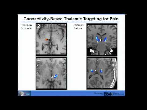 Neural Prosthesis Seminar, Nader Pouratian, MD, PhD