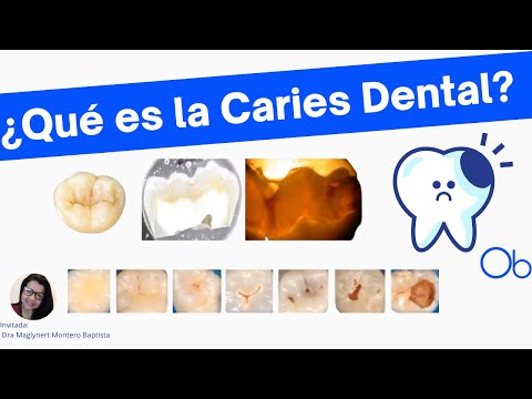¿Qué es la CARIES DENTAL?