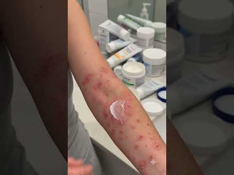 My skin story 