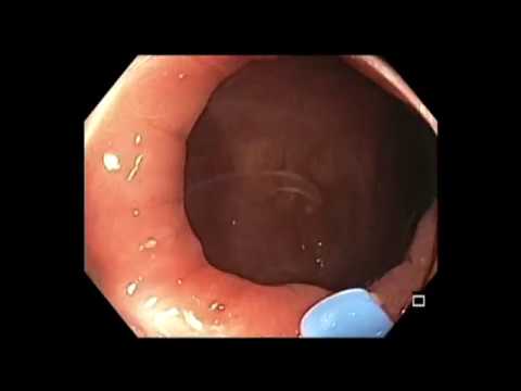 Colonoscopy: Rectum - Large Flat Lesion - Subtle lesion - Marking & EMR